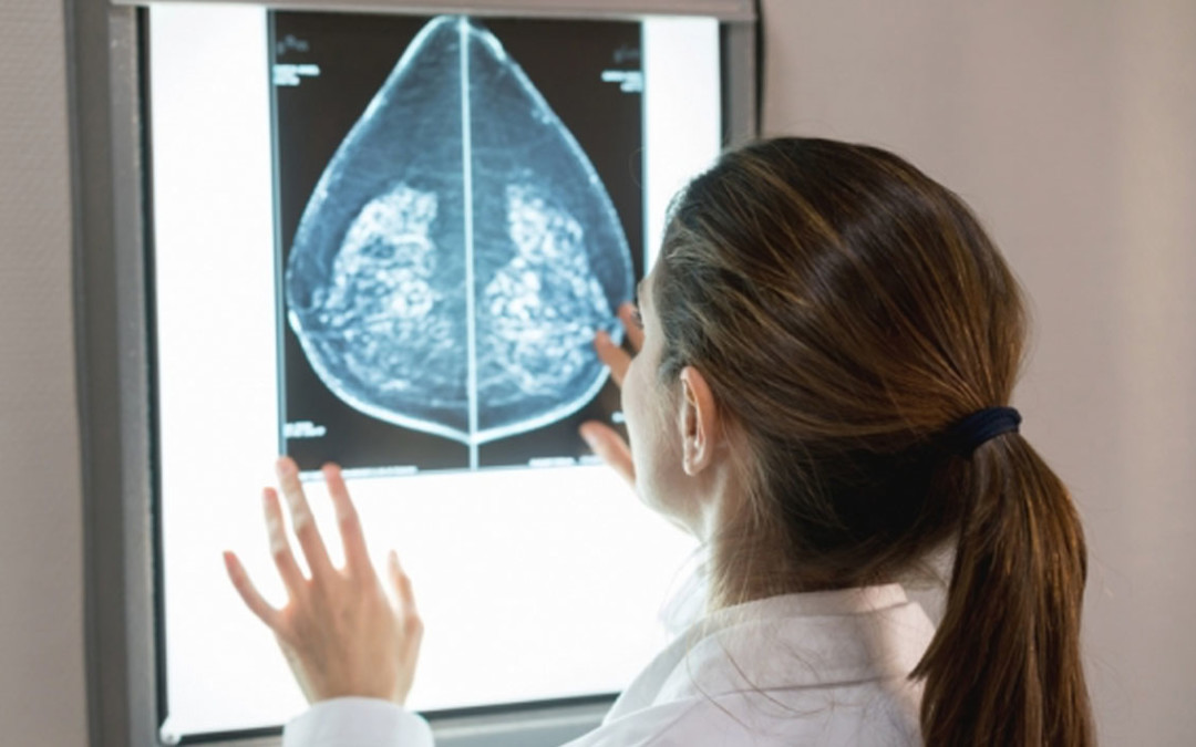 Inteligência artificial do MIT é capaz de identificar câncer de mama tão bem quanto um radiologista
